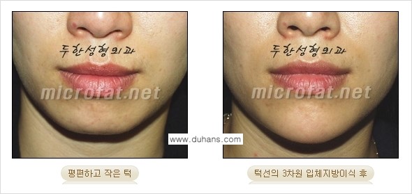 [두한성형외과의 경쟁력 미세지방이식] - [무턱교정 - 턱 미세지방이식 안내 2.] 관련 이미지 12
