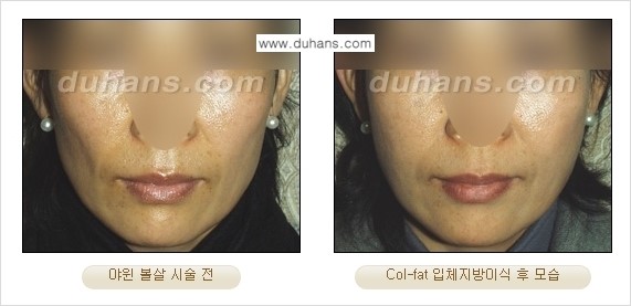 [두한성형외과 경쟁력 미세지방이식]-[Col-fat 입체지방이식 사례 안내] 관련 이미지 15