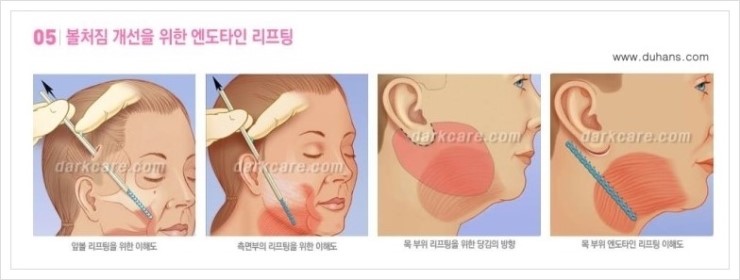 [두한성형외과 경쟁력 주름성형] - [피부 처짐, 표정주름에 효과적인 내시경 엔도타인 리프팅] 관련 이미지 7