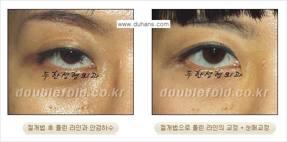 [두한성형외과 NO.1 경쟁력 눈성형] - [풀린 쌍꺼풀 절개법으로 교정하는 방법] 관련 이미지 4