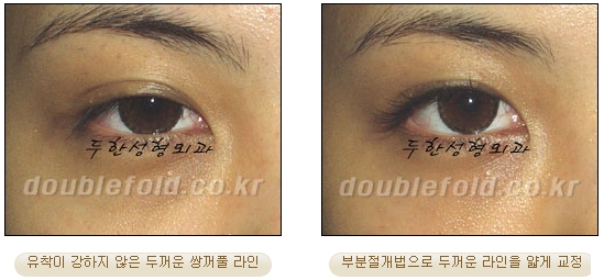 [두한성형외과 눈재수술] - [부분절개법 재수술] 관련 이미지 37