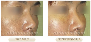 DuHan Plastic Surgery Revision Rhinoplasty - AlloDerm Nose Surgery, SureDerm Nose Surgery image 15