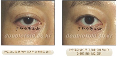 [두한성형외과 쌍커풀재수술] - [심한 소세지눈, 두줄따기, 쌍꺼풀 흉터] 관련 이미지 23