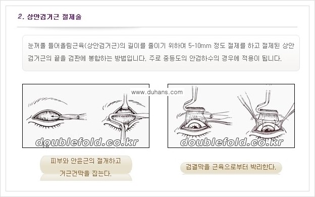 [두한성형외과 경쟁력 쌍꺼풀 재수술(극한 재수술)] - [안검하수(졸리운 눈매) 교정 안내 2.] 관련 이미지 6