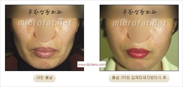[두한성형외과 경쟁력 지방이식] - [두한 자가지방이식 클리닉 안내]​ 관련 이미지 40