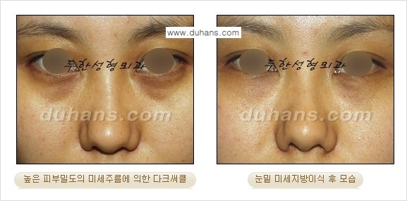 [두한성형외과 경쟁력 미세지방이식] - [다크써클 & 눈밑주름 미세지방이식 4.] 관련 이미지 4