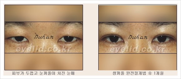 [두한성형외과 경쟁력 눈성형] - [눈성형 방법에 대한 흔한 질문과 답변 안내] 관련 이미지 6