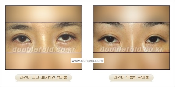 [두한성형외과 경쟁력 쌍꺼풀 재수술] - [쌍꺼풀 재수술에 대한 최선의 대안 제시] 관련 이미지 2