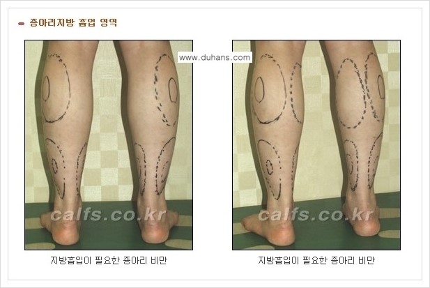 [두한성형외과 경쟁력 멀티종아리성형] - [정교한 미세흡입관 종아리 지방흡입술] 관련 이미지 2