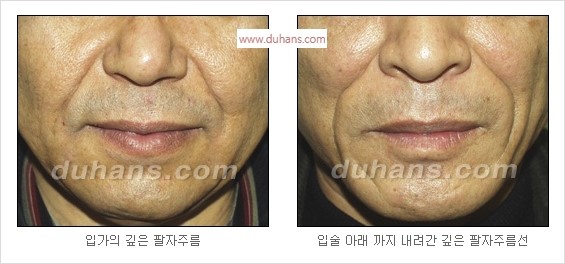 [두한성형외과 경쟁력 주름성형] - [입가주름과 코옆 팔자주름제거 지방이식 시술의 효과] 관련 이미지 3