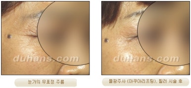 [Wrinkle Correction, Duhan Plastic Surgery] - [Wrinkle Botox, Wrinkle Filler, Wrinkle Fat Grafting] image 22