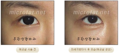 두한성형외과 눈밑성형 - 애교필러 후 눈밑재수술 관련 이미지 43