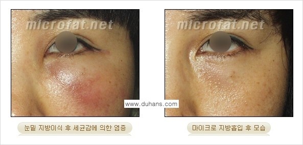 [두한성형외과 경쟁력 미세지방이식] - [미세지방이식 부작용 교정] 관련 이미지 5
