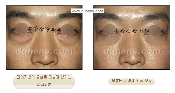 [두한성형외과 젊은 눈매 안검성형] - [눈밑 지방제거의 수술 전후 안내 ②] 관련 이미지 6