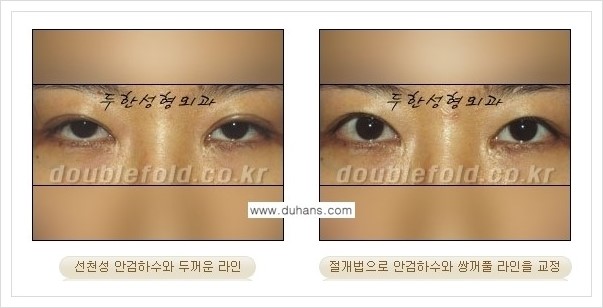 [두한성형외과 경쟁력 쌍꺼풀 재수술, 극한 재수술] - [안검하수(졸린눈매) 교정 방법 안내] 관련 이미지 4