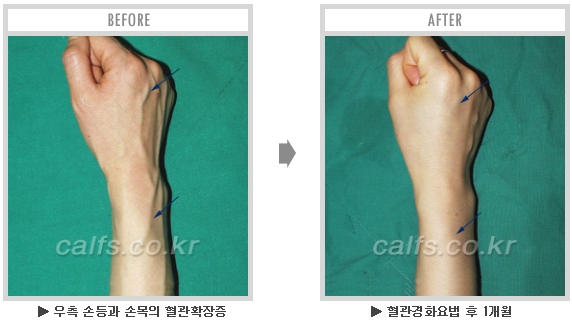 [종아리성형 두한성형외과] - [종아리수술에 대한 자주하는 질문과 답변 모음] 관련 이미지 47