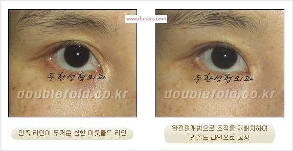 [두한성형외과 경쟁력 눈성형] - [완전절개법(Full incision method)의 재수술 과정] 관련 이미지 8