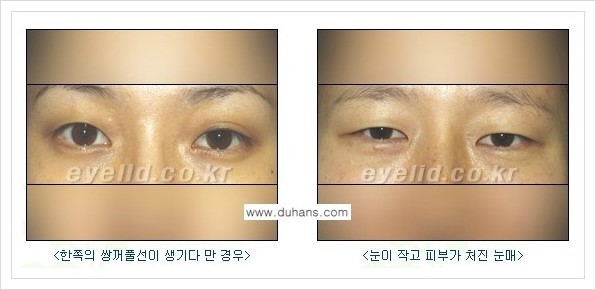 [두한성형외과 경쟁력 눈성형] - [퀵쌍꺼풀 - 부분절개법] 관련 이미지 1