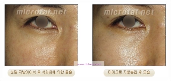[두한성형외과 경쟁력 지방이식] - [두한 자가지방이식 클리닉 안내]​ 관련 이미지 93