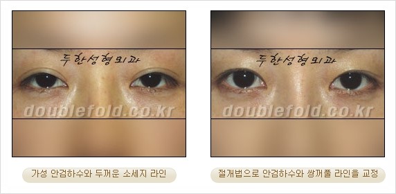 [두한성형외과 경쟁력 눈성형] - [안검하수(졸리운 눈매) 교정 방법 안내] 관련 이미지 22