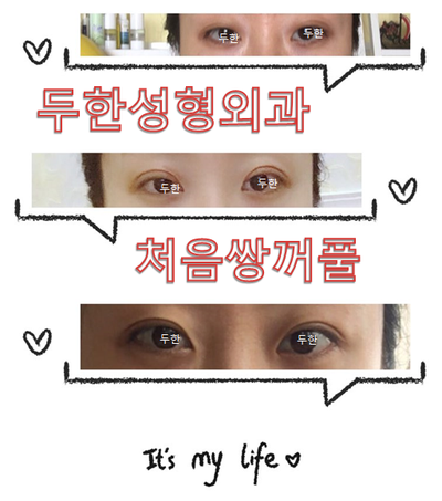 [Duhan Plastic Surgery Eye Surgery] - [First Double Eyelid Surgery] image 1