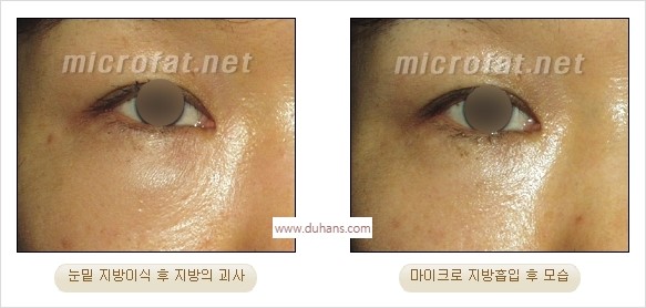 [두한성형외과 경쟁력 미세지방이식] - [지방이식 부작용 교정 모습 안내] 관련 이미지 33