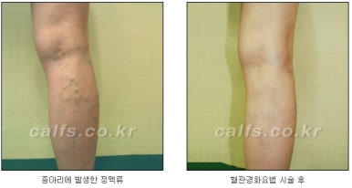 [Duhan Plastic Surgery Calf Clinic] - [Calf Contouring Guide] image 40
