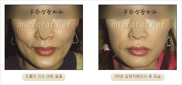 [두한성형외과 경쟁력 지방이식 리더] - [Col-fat(콜펫)지방이식, 3차원 입체지방이식, 2차원 평면지방이식] 관련 이미지 55