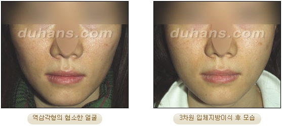 [두한성형외과 얼굴자가지방이식] - [볼살, 이마, 측두부] 관련 이미지 14