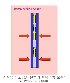 [두한성형외과 경쟁력 정맥류 치료] - [정맥류의 원인과 문제점, 정맥류 진단 방법] 관련 이미지 9