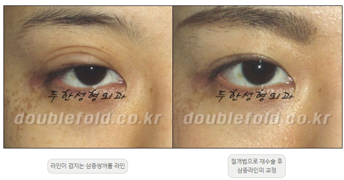 [Double Eyelid Surgery Duhan Plastic Surgery] - [Revision Methods] image 24