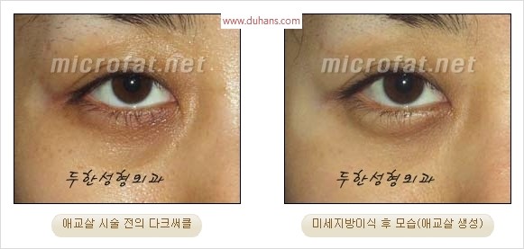 ​﻿[두한성형외과 경쟁력 지방이식] - [눈밑 애교살 시술을 위한 미세지방이식] 관련 이미지 14