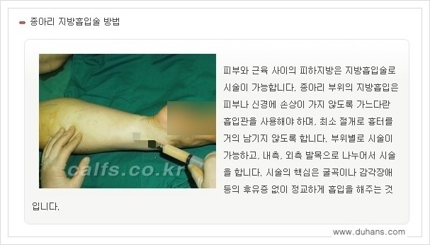 [두한성형외과 경쟁력 멀티종아리성형] - [나에게 맞는 종아리 시술 방법과 종류 안내 ②] 관련 이미지 5