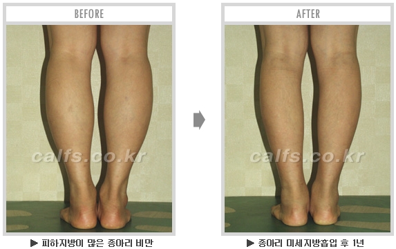 [종아리성형 두한성형외과] - [종아리수술에 대한 자주하는 질문과 답변 모음] 관련 이미지 75