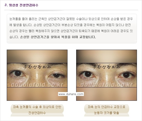 [두한성형외과 NO.1 "극한 눈(쌍꺼풀 재수술)"] - [안검하수(졸린눈매) 재수술 안내 1.] 관련 이미지 6