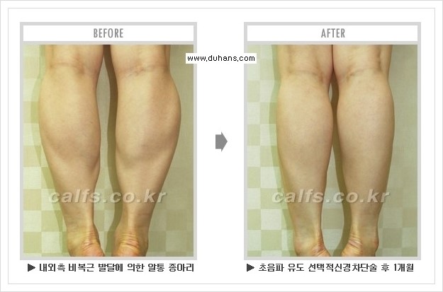 [두한성형외과 경쟁력 멀티종아리성형] - [종아리성형 방법별 전후 주의사항] 관련 이미지 13