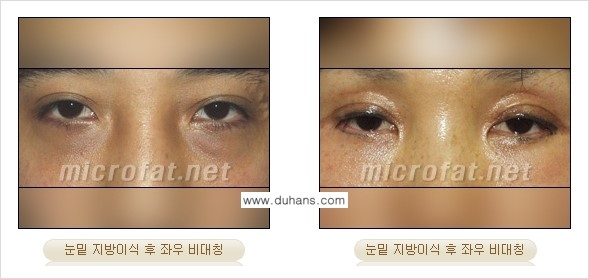 [두한성형외과] - [제대로 된 지방이식으로 부작용에서 탈출하자!] 관련 이미지 5