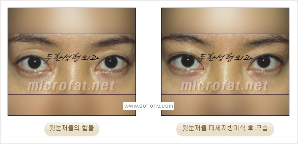[두한성형외과 경쟁력 미세지방이식] - [꺼진(함몰된) 윗눈꺼풀 미세지방이식] 관련 이미지 18
