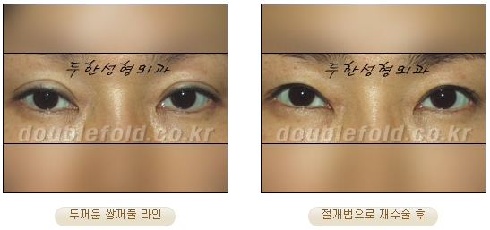 [Duhan Plastic Surgery Double Eyelid Revision Surgery] - [Ptosis Correction Surgery] image 45
