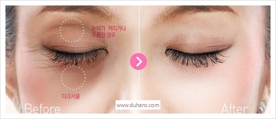 [두한성형외과 경쟁력 눈밑성형] - [다크써클 + 눈위 지방이식 콤비 프로그램] 관련 이미지 1