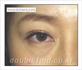 [두한성형외과 경쟁력 눈성형] - [나에게 맞는 맞춤 쌍꺼풀 찾기] 관련 이미지 17