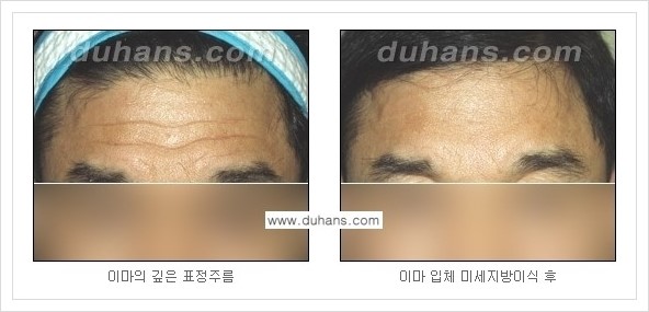 ​[두한성형외과 경쟁력 주름성형] - [주름교정을 위한 미세지방이식 안내 1.] 관련 이미지 12