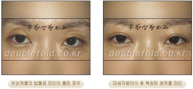 [두한성형외과 쌍커풀수술] - [쌍꺼풀지방이식] 관련 이미지 34