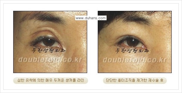 [두한성형외과 경쟁력 쌍꺼풀 재수술] - [여러번의 쌍꺼풀 재수술로 인한 흉살이 두터운 경우 안내] 관련 이미지 1