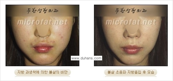 [두한성형외과 경쟁력 지방흡입] - [얼굴, 볼살, 턱살, 턱선의 초음파 지방흡입] 관련 이미지 19