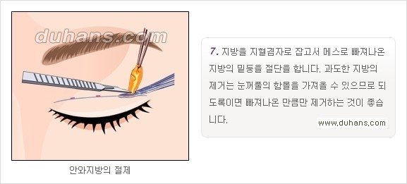 ​[두한성형외과 경쟁력 눈성형] - [자연스럽고 아름다운 쌍꺼풀의 기준] 관련 이미지 13