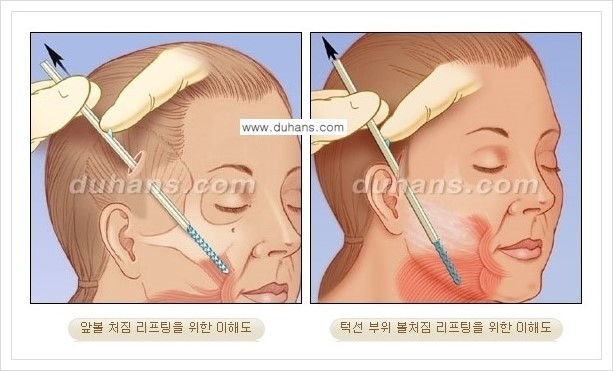 [두한성형외과 경쟁력 주름교정술] - [엔도타인 리프팅 안내 ②] 관련 이미지 2