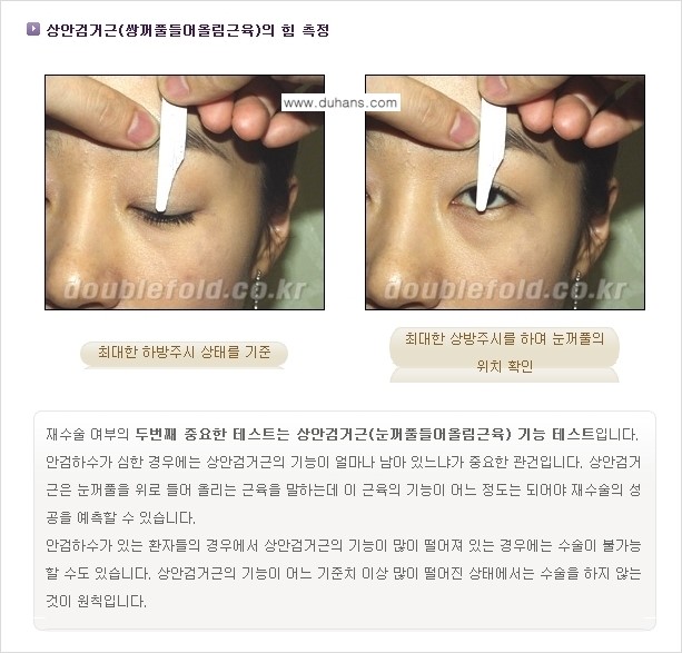 [두한성형외과 경쟁력 쌍꺼풀 재수술] - [쌍꺼풀 재수술에 대한 최선의 대안 제시] 관련 이미지 6
