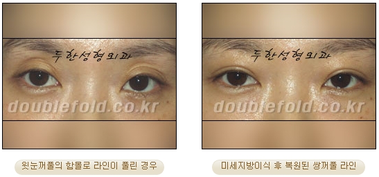 [두한성형외과 쌍커풀수술] - [눈성형 방법에 대한 자주하는 질문과 답변] 관련 이미지 108