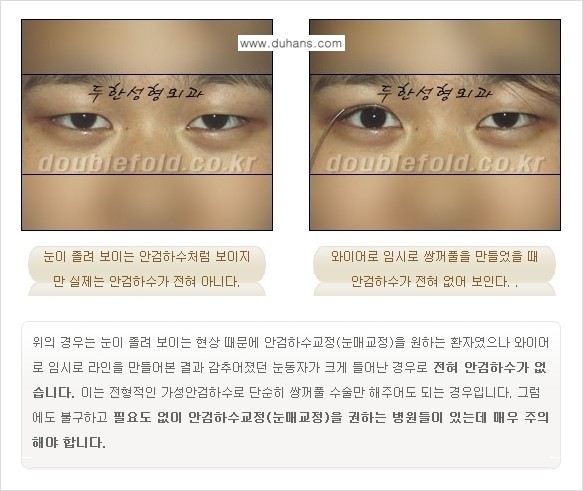 [두한성형외과 경쟁력 눈성형] - [안검하수(졸린 눈매) 재수술 안내 ①] 관련 이미지 5